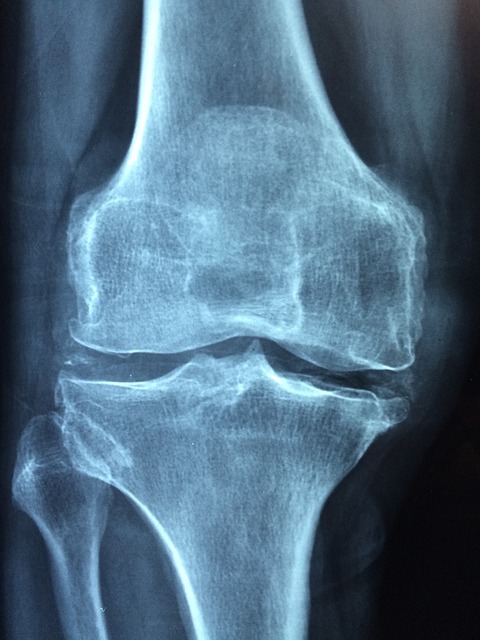 Osteoporosis On the Rise